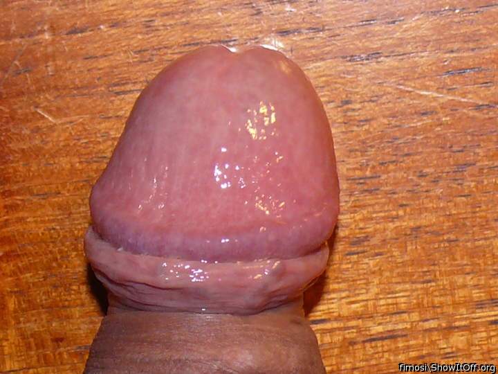 Photo of a penis from Fimosi