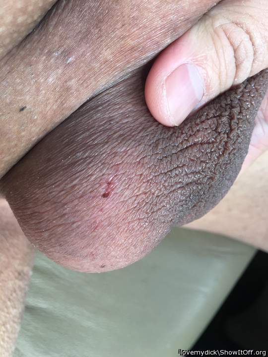 A bruise after long hours of bondage
