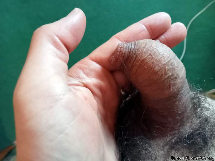 Who will take off my foreskin?