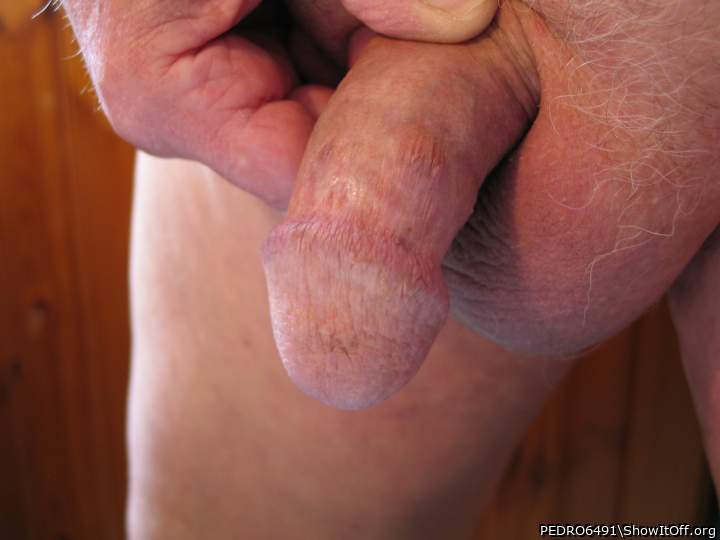 Scars were my skin bridges were removed 2