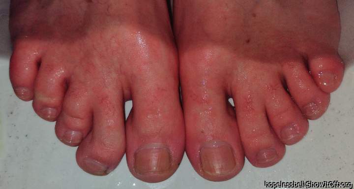 Webbed toes