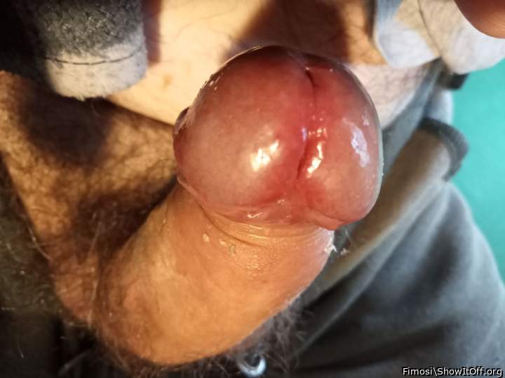 Photo of a pecker from Fimosi