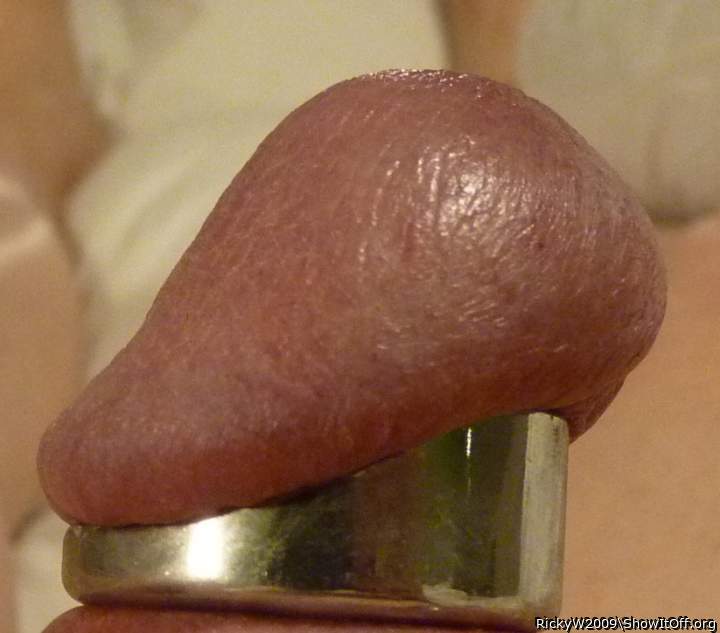 Glans Ring in my Sulcus