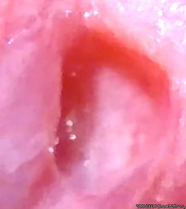 Hole spread wider, you can see the skin tag & veins inside.