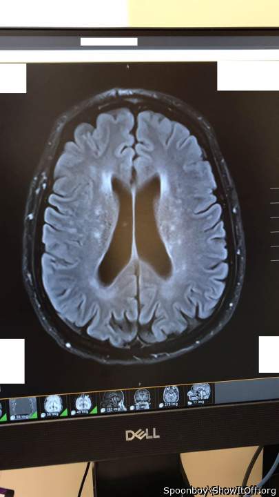 mri