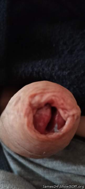 Photo of a penile from James24