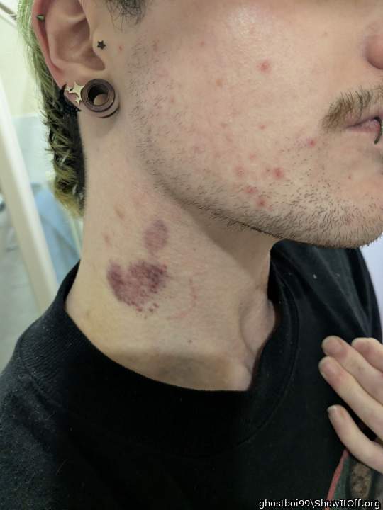 hickeys