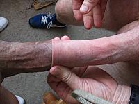 penile